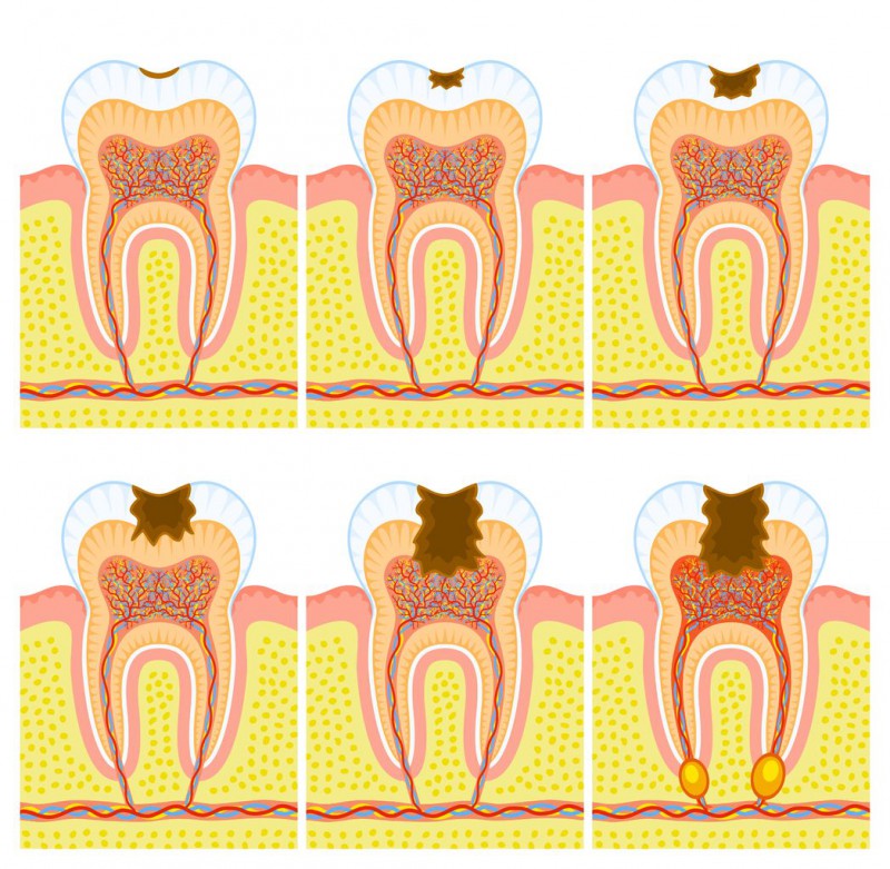 Imagen de Caries dentales y empastes