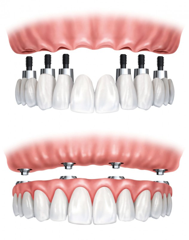 Imagen de PrÃ³tesis dentales fijas