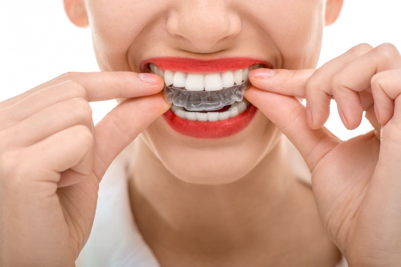 Imagen de Â¿Por quÃ© se produce el desgaste dental?